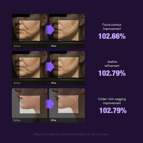 EOA HIFU Fulthera Pro