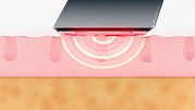 6.78MHz Pro-Grade RF Technology <br>for Deep Skin Firming